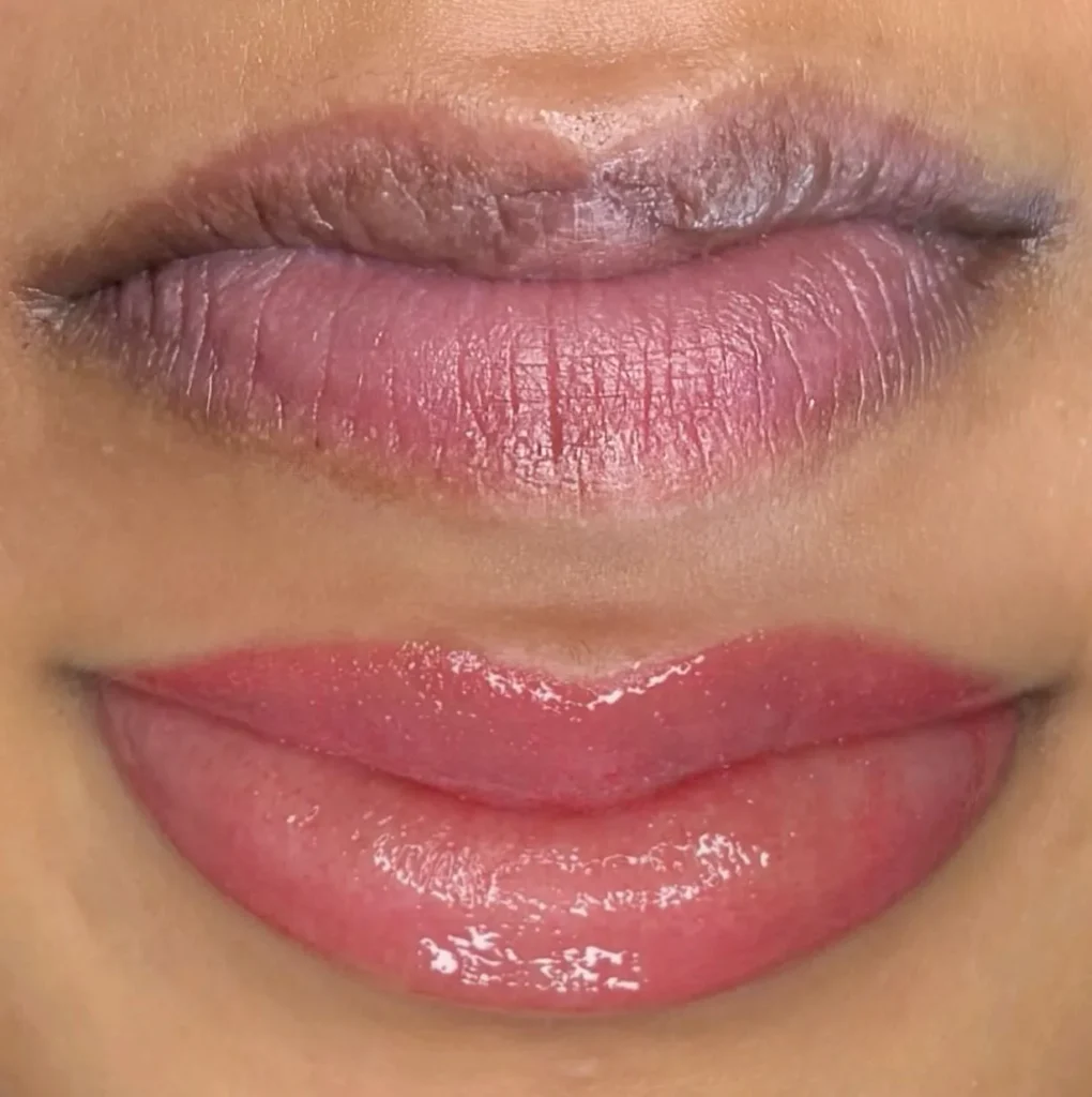 New Age Auto Store | Dark Lip Neutralization Risks Melbourne Scabbing and Peeling