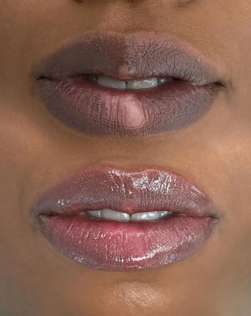 New Age Auto Store | Dark Lip Neutralization Risks Melbourne Temporary Pigmentation Changes