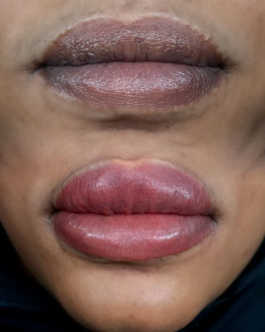 New Age Auto Store | Dark Lip Neutralization Risks Melbourne What is Dark Lip Neutralization